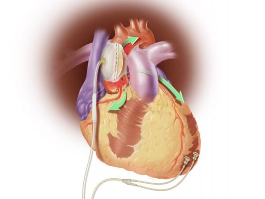 Sunshine Heart Borrows $2 Million For C-Pulse Heart Failure Device